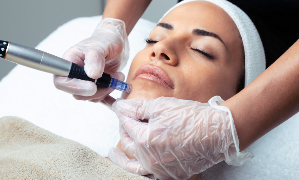 The Nano-Needle Facial: A Revolution in Skin Rejuvenation